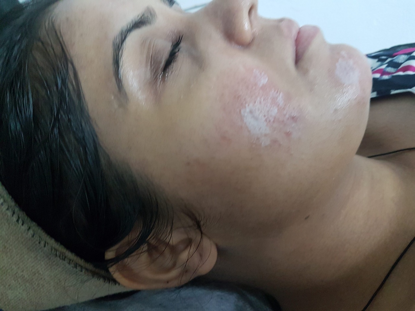 صورة مرجعية لعلاج حب الشباب وتحسين ملمس البشرة