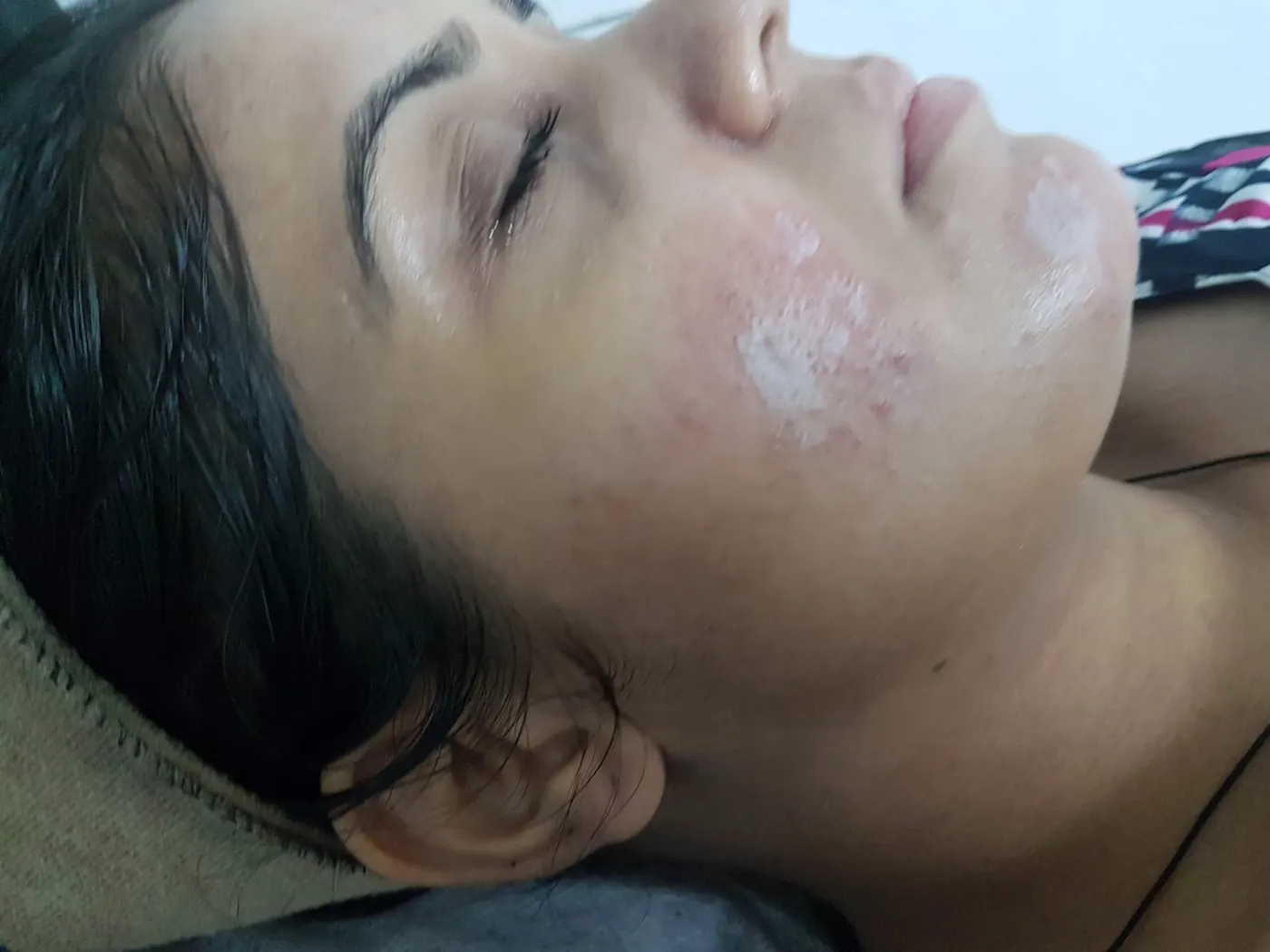Reference image for acne treatment and skin texture improvement